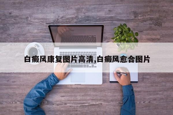 白癜风康复图片高清,白癜风愈合图片